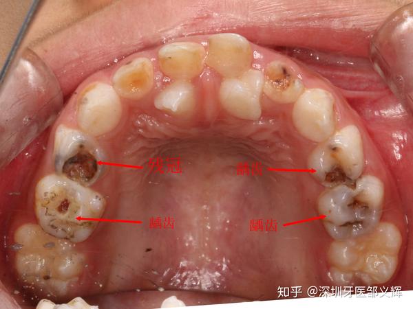 7岁男童满嘴烂牙替牙期新长的牙还不是正常的牙我该怎么办