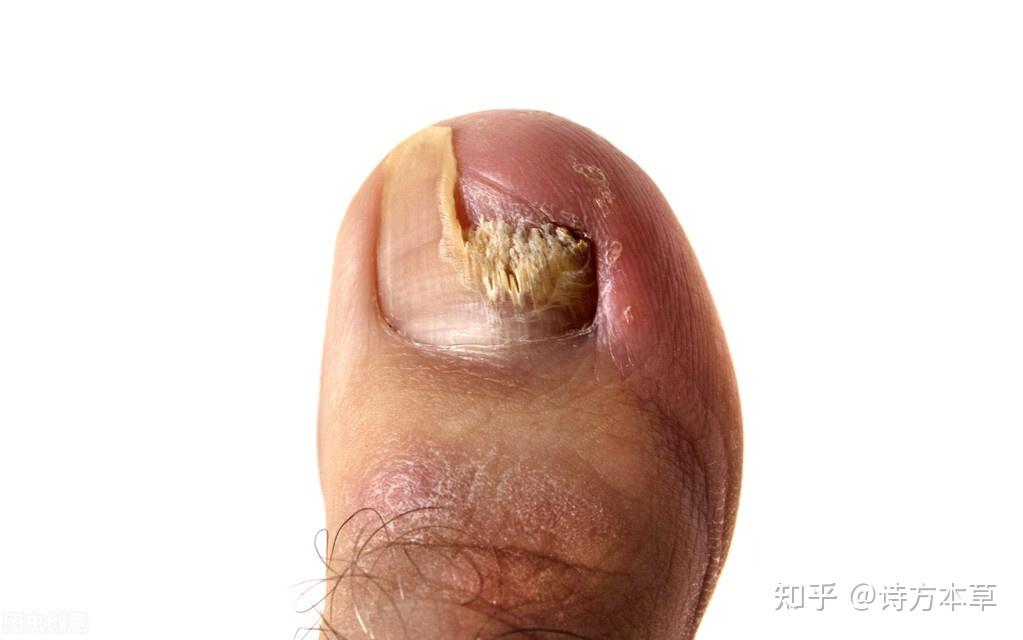灰指甲的特征与预防要点!