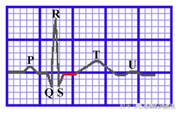 qrs电轴 zhuanlan.zhihu.com