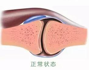 膝关节髌腱下滑囊炎的自我康复