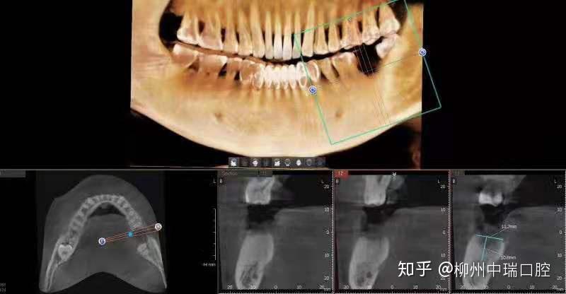 经检查后发现:黄先生左下后牙牙(37#)缺失,牙槽骨吸收严重,智齿松动.