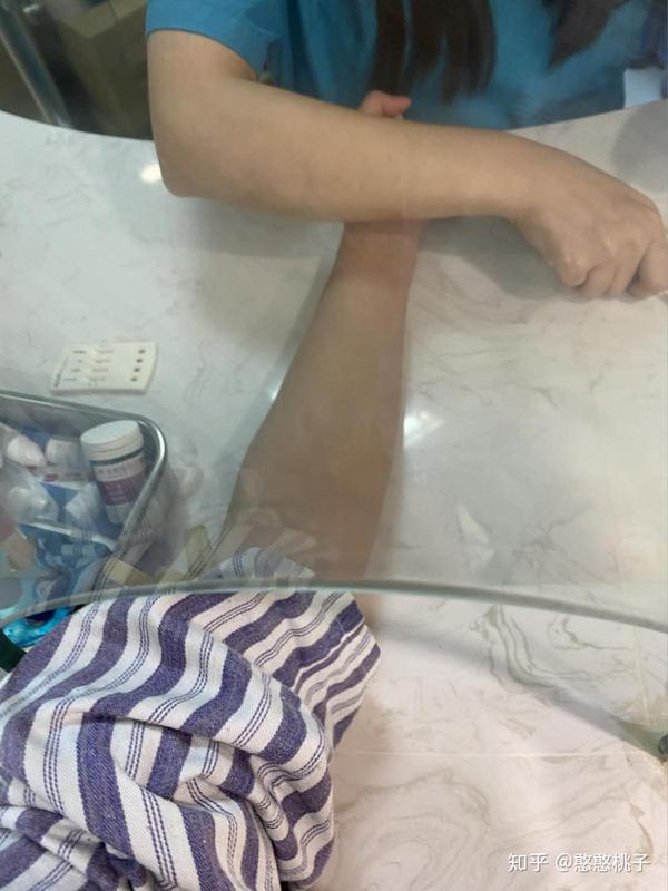 北京手臂吸脂术后恢复记录分享,记录真实状态|北京吸脂医院医生哪里好