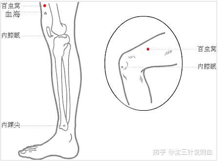 01百虫窝穴的准确位置图 02位置描述 百虫窝属于经外奇穴,穴位于大腿