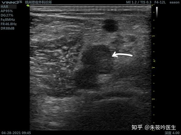 查体见右侧小腿稍粗,腓肠肌触之柔软,无挤压疼痛,双侧小腿homan征(-)