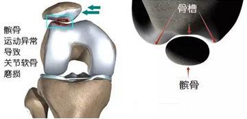 髌股关节炎