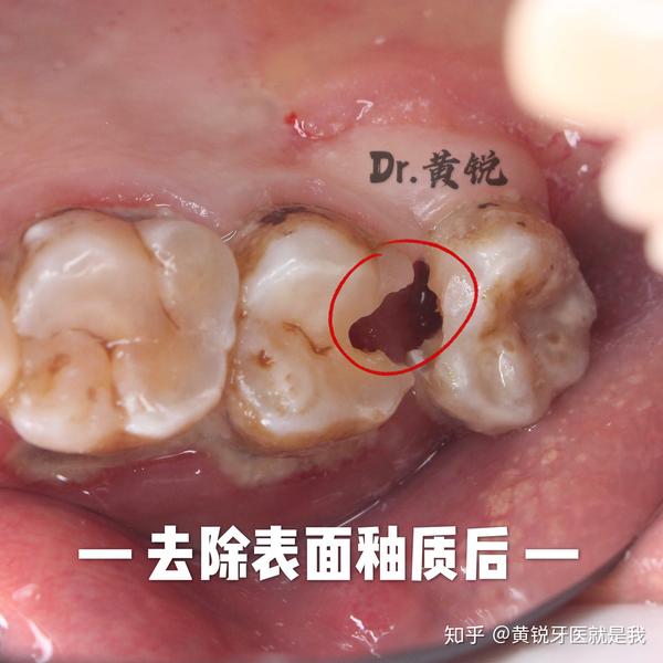 在去除表层釉质后见到了隐藏在两颗牙齿邻面的深大龋洞(下图圆圈处)