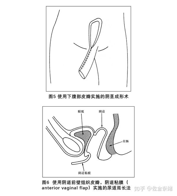 女性外尿道口因为开口于比耻骨更里的位置,之后在耻骨上形成阴茎的