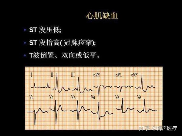 博声医疗:心肌缺血,心肌缺血怎么办?