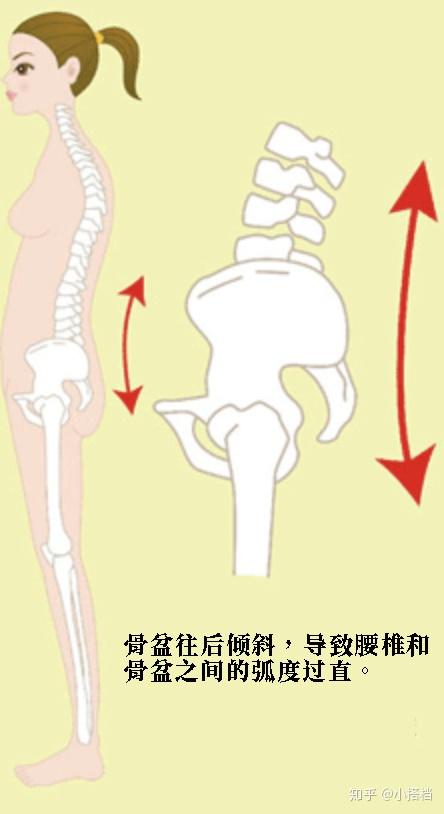 骨盆前倾和后倾傻傻分不清?一文搞懂这俩体态问题的异同