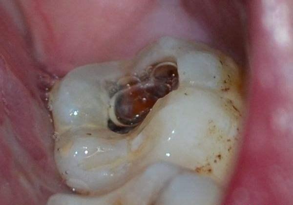 牙齿上出现一个大洞抽掉牙神经牙齿就死了这是真的吗