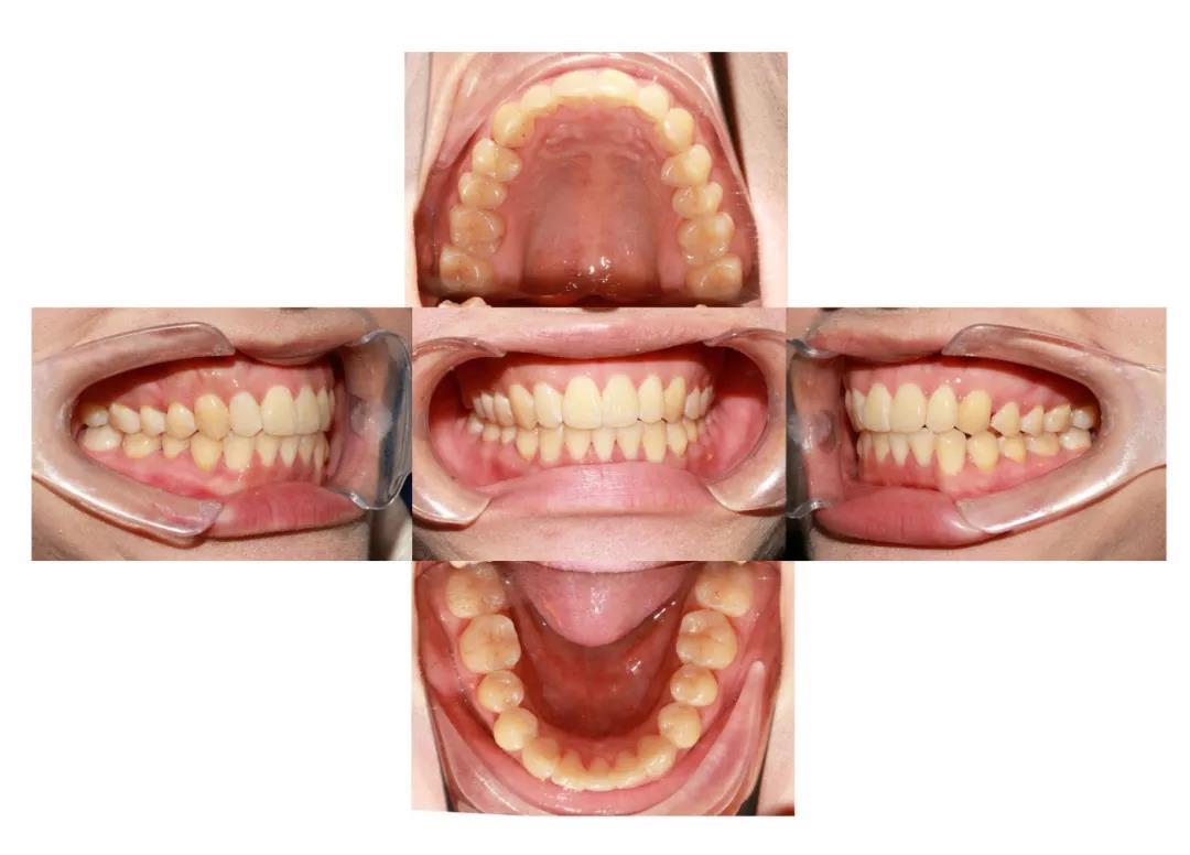 牙齿不齐拥挤案例分享——可以收获健康口腔!