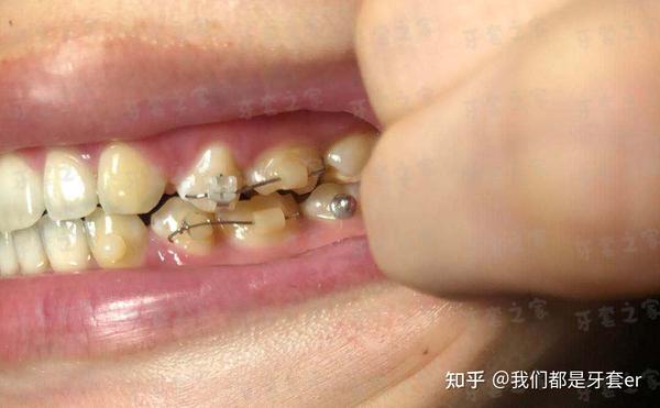 ebrace舌侧矫正 | 骨性龅牙,露龈笑,拔了4颗4号牙矫正