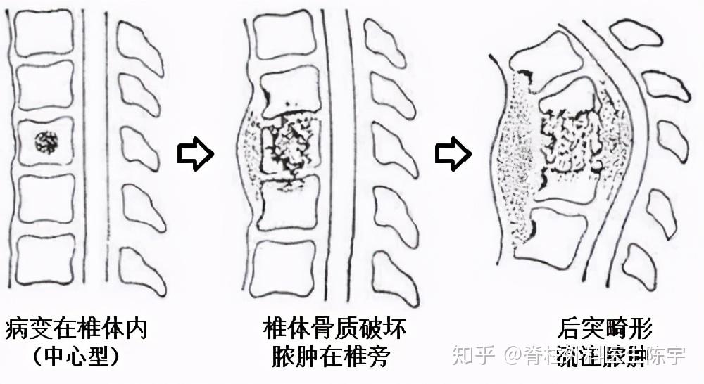 脊柱结核什么时候需要手术治疗