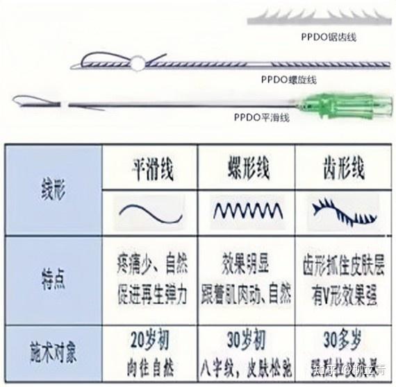 没有齿的平滑线又分为:螺旋,多根,有长有短,有粗有细等等.