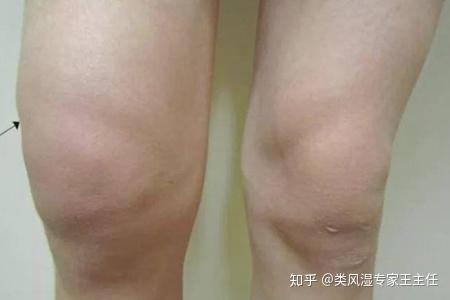 膝盖积液能否做康复训练