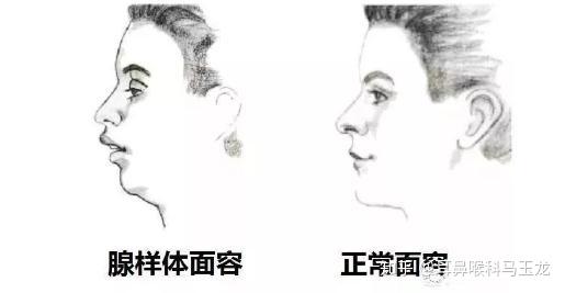 腺样体面容应该怎样判断?