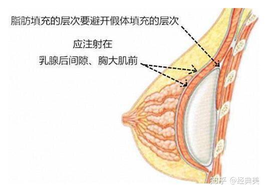 自体脂肪隆胸的原理   自体脂肪注射隆胸是将身体其他部位多余的脂肪