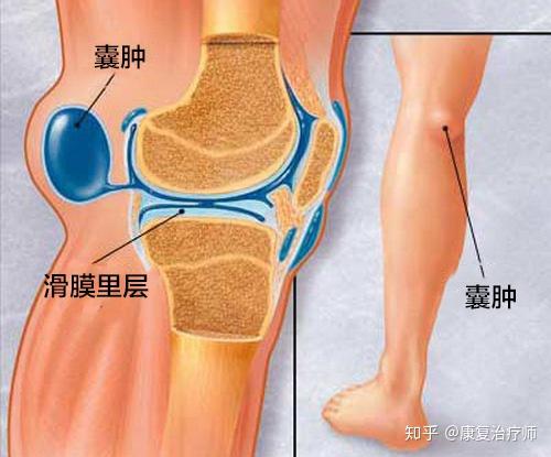 膝关节肿胀的原因是什么