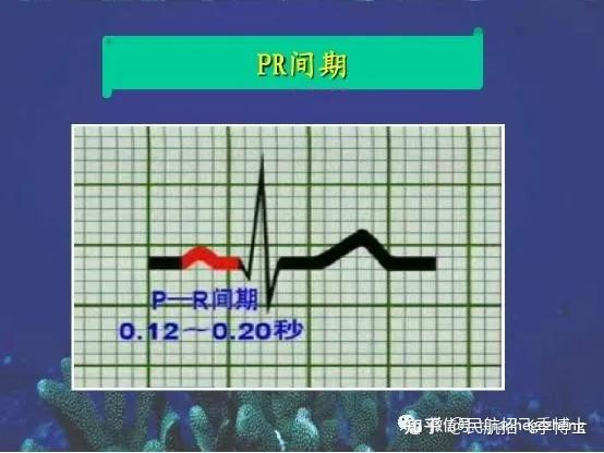 招飞体检常见心电图术语及鉴定短pr间期