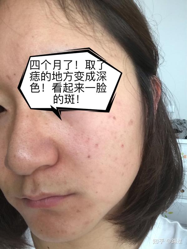 去医院问了医生,祛痣的位置变黑回慢慢恢复,就是要注意防晒.