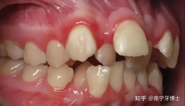前移后牙的目的,缓解面部前突,从而使得患者的面部侧貌更美 利用拔牙