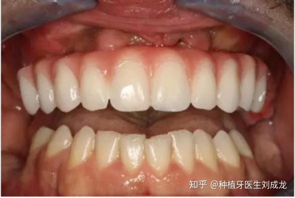 郑州种全口/半口all-on-4种植牙是啥体验?有好的医生推荐没?