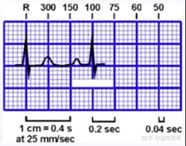 心电图速记口诀,赶快收藏起来吧!