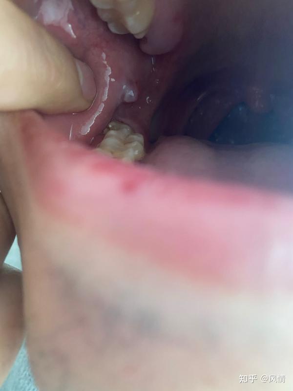 口腔长了一个肉瘤咋回事