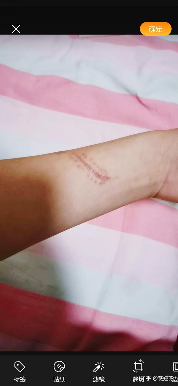 伤口缝针一个多月了,为什么手一压还是疼呢,现在伤疤是这样的恢复情况