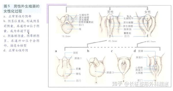 性别畸形科普五之男性假两性畸形