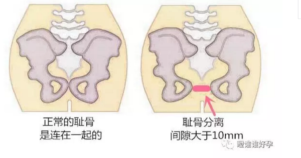 耻骨联合分离偏爱哪些孕妈