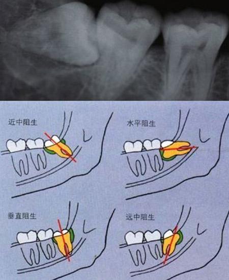 需要通过牙片确定智齿的牙根以及阻生的位置