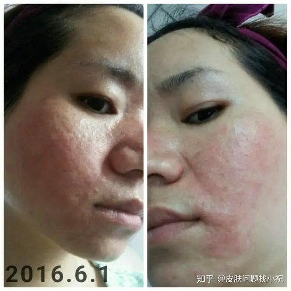 痘痘系列:4激素痘 激素脸