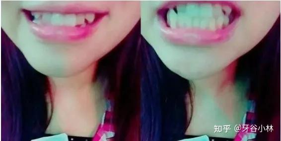 带上牙套后4个月,正在和矫正