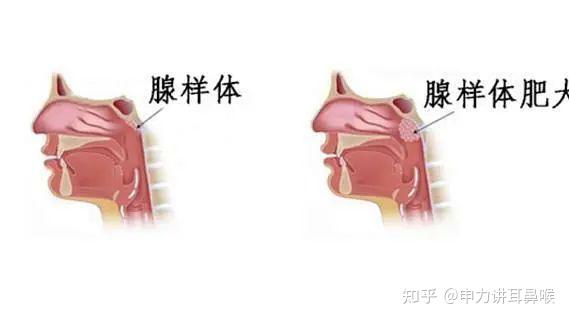腺样体:位于鼻腔后方,口咽上方的一团淋巴组织,在正常生理情况下,6-7