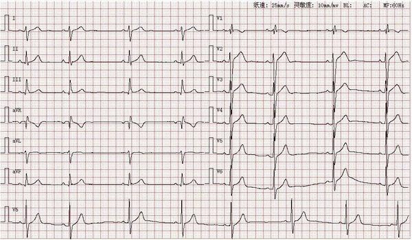 心电图图库丨左后分支阻滞系列