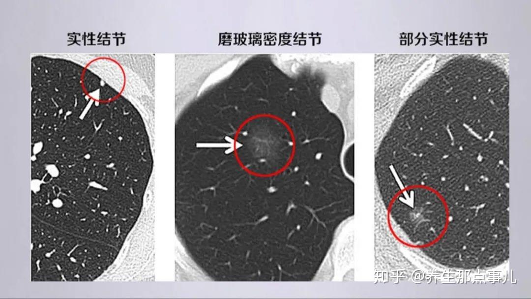 体检查出肺结节担心是癌听听专家怎么说