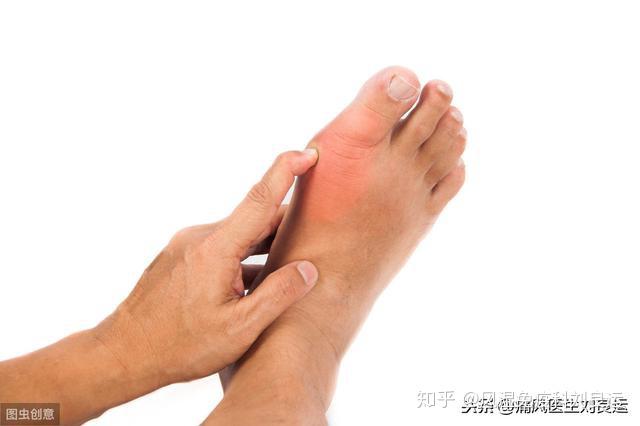 痛风通常发生在脚的第一跖趾关节