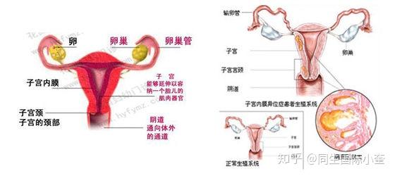 左图为正常女性的生殖系统,右图为子宫内膜异位症患者病变部位示意图