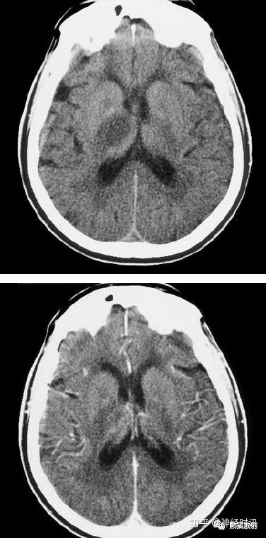 脑血管病 | 脑梗死的演变,血供区域分布,ct表现