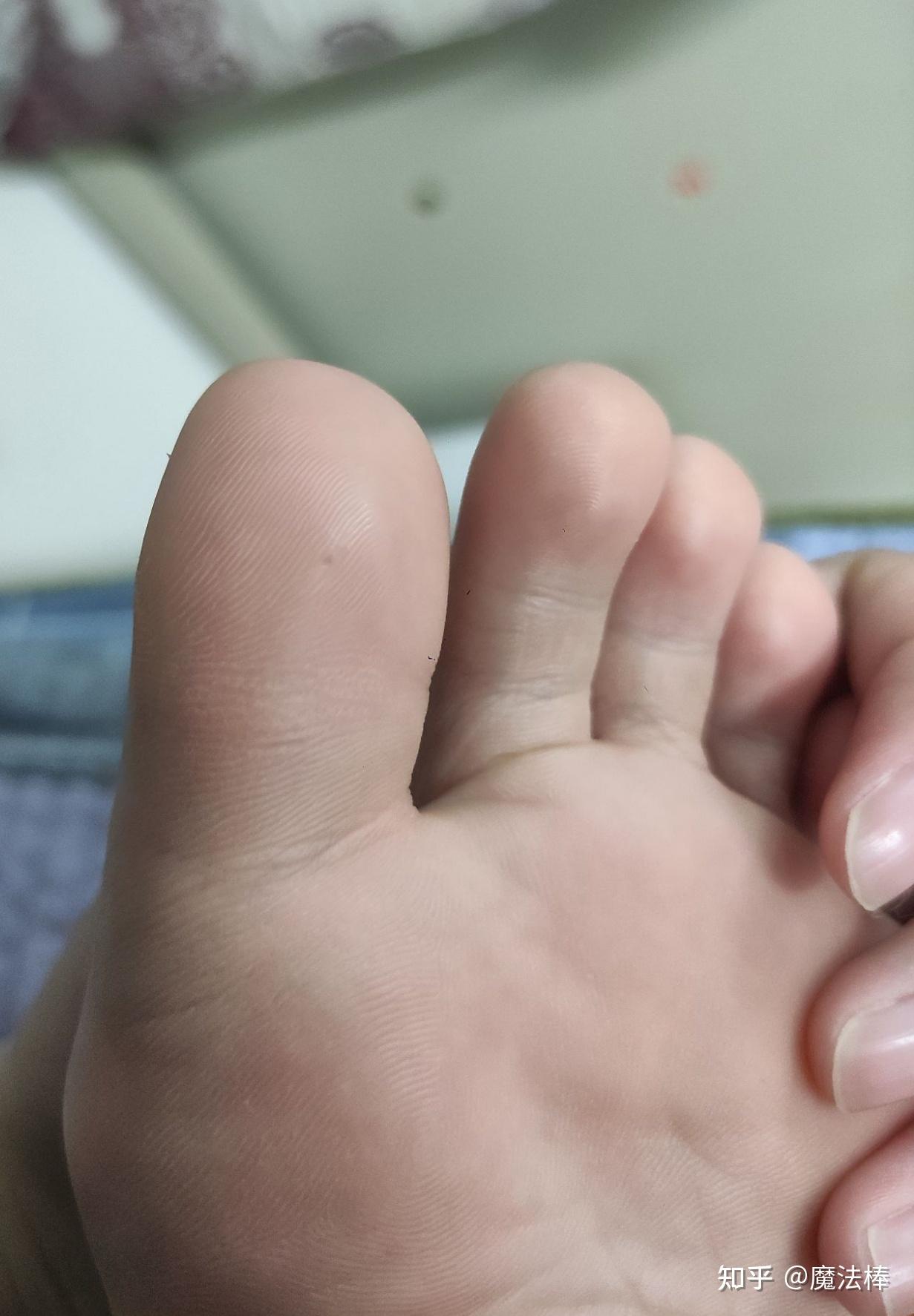加油和跖疣做斗争
