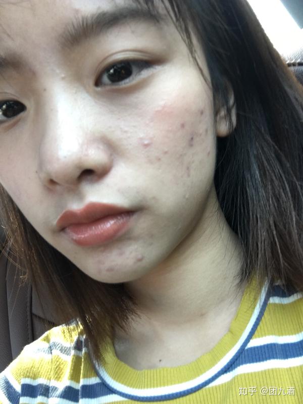 怎么看待五官漂亮但是皮肤差的女性?