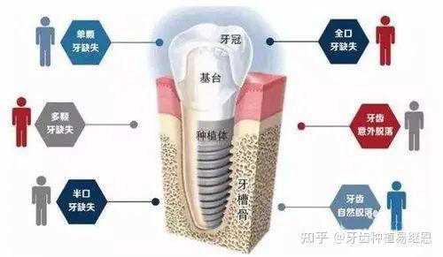 被誉为"人类的第三幅牙齿",3d导板精准种植,种植过程安全舒适,微创无