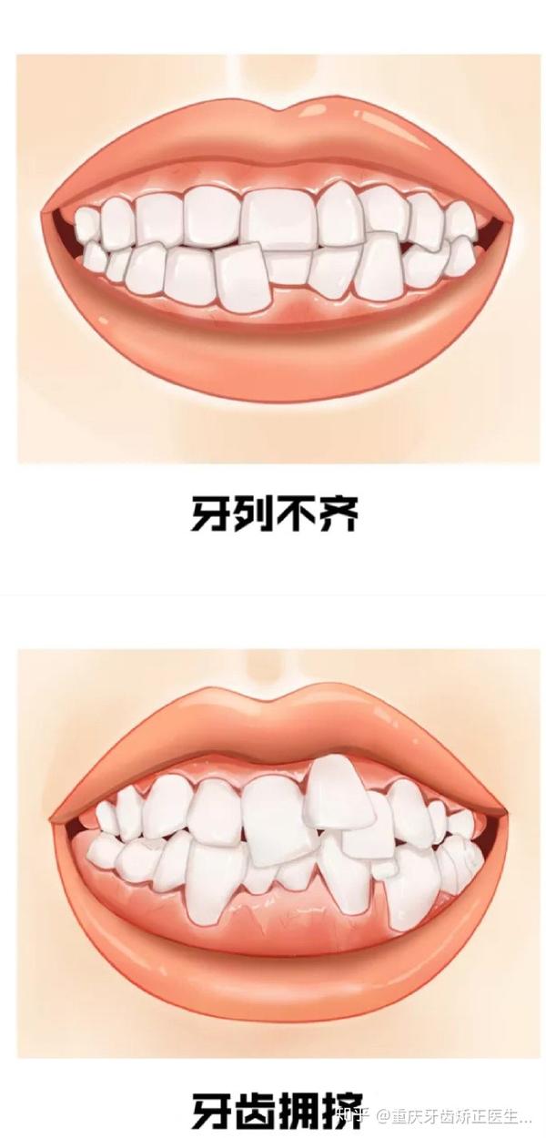 重庆牙齿矫正案例牙列不齐牙列拥挤