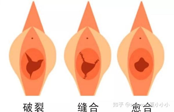 科普:私处整形,女性如何在两性关系中保持魅力