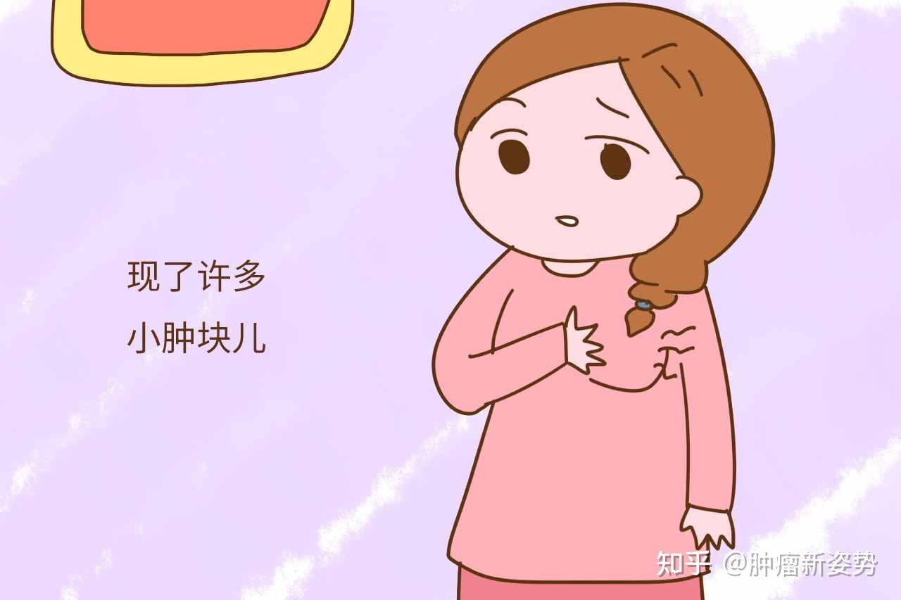 乳房反复湿疹竟是癌症缠身