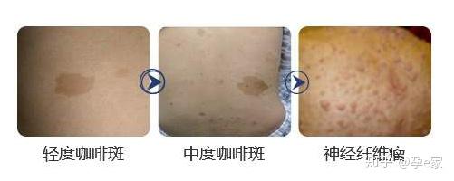 牛奶斑 zhuanlan.zhihu.com