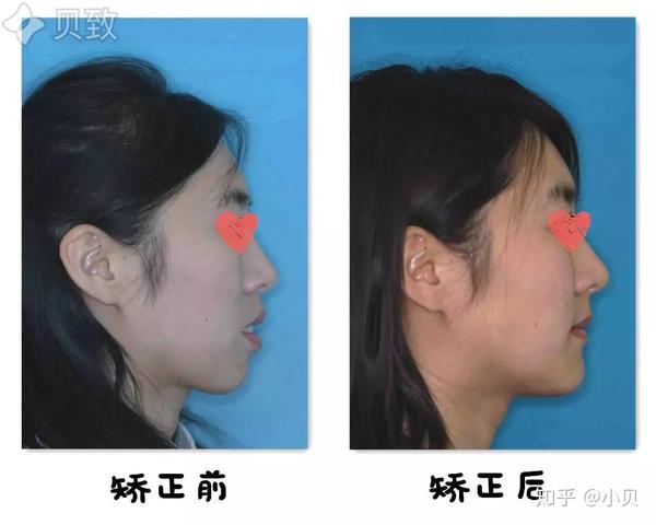下巴后缩怎么办?