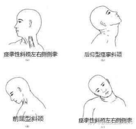 为什么建议痉挛性斜颈患者不要做手术?