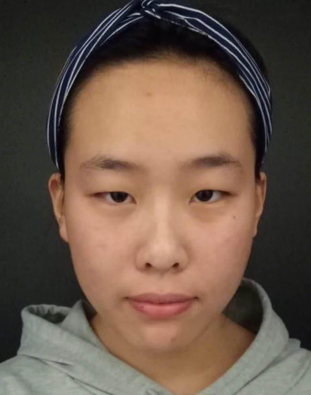 不是每个人都适合单眼皮,双眼皮手术术后分享,竟然能这么自然